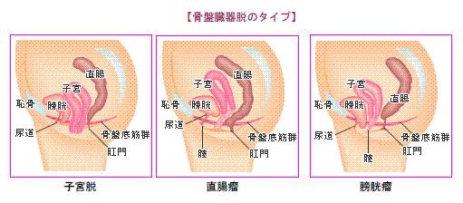 子宮脱センター図2