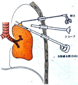 胸腔鏡手術操作の基本