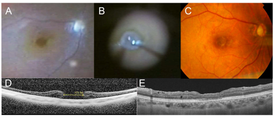 大型黄斑円孔に対する自家網膜移植術