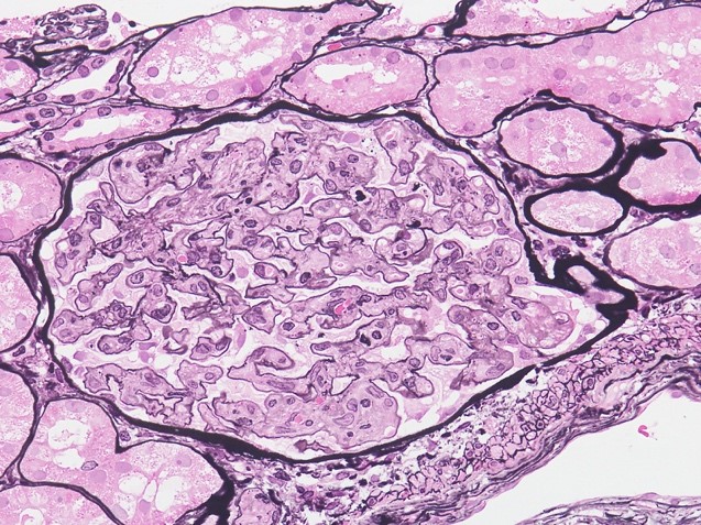 TAFRO症候群のglomerular endotheliosis、PAM-HE染色