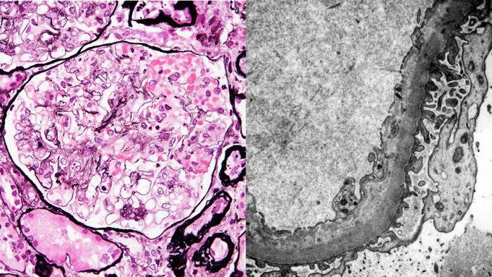 Thrombotic microangiopathy, 左：PAM-HE、右：電子顕微鏡×12,000