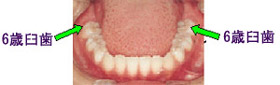 6歳臼歯の写真