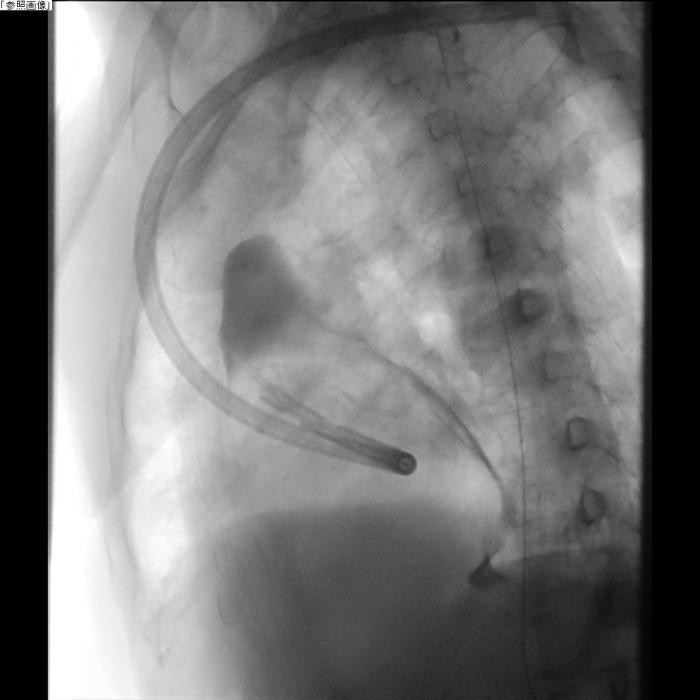 胸腔造影下フィブリン糊肺瘻閉鎖法2
