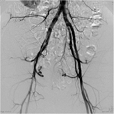 骨盤部動脈造影