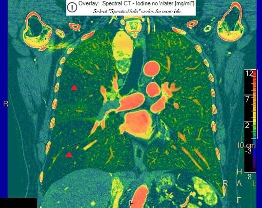 肺動脈塞栓症（ヨード密度画像）