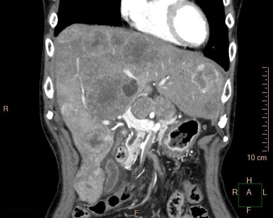 肝転移（120kVp）
