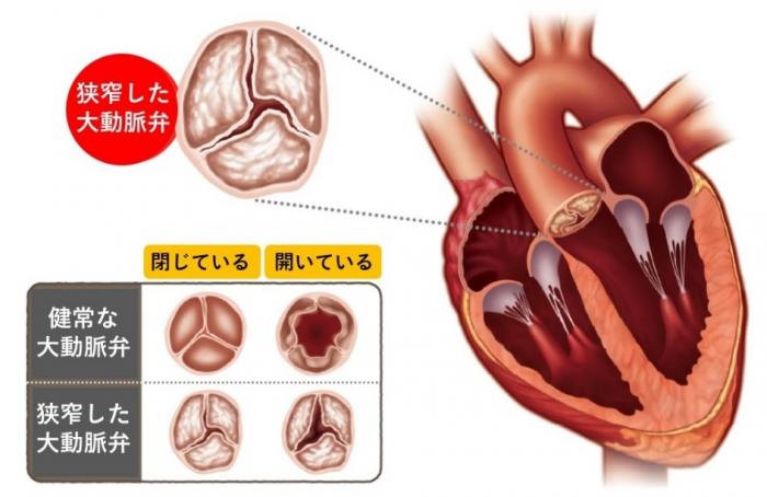 弁膜症