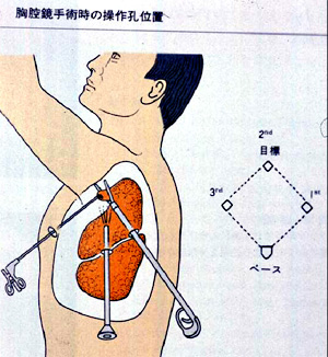 胸腔鏡手術操作の基本