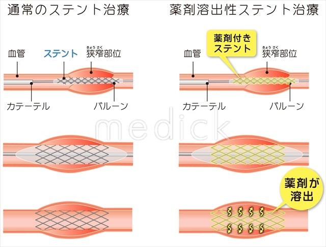 ステント治療