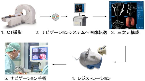 慢性副鼻腔炎