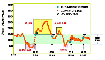 持続グルコース測定