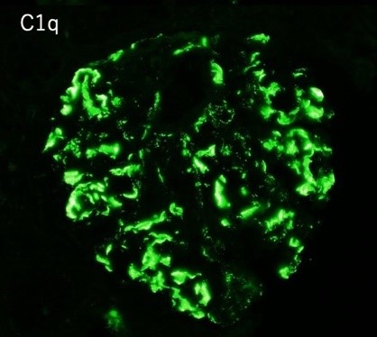 C1q nephropathyの糸球体：蛍光抗体法