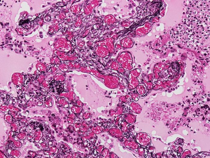 pulmonary capillary hemangiomatosis、剖検肺、PAM-HE染色