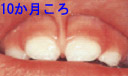 10か月ころの歯の写真