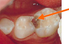 歯と歯の間のむし歯の写真