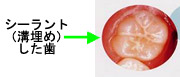 シーラント（溝埋め）した歯の写真