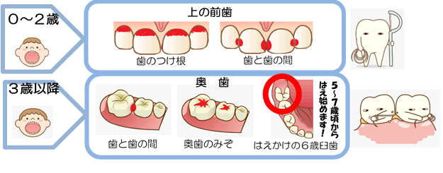 乳歯のむし歯になりやすい部位。0～2歳は上の前歯の歯の付け根と歯と歯の間。3歳以降は奥歯の歯と歯の間、溝。5歳以降は大人の歯が生え始めますが、生えかけの歯もむし歯になりやすい。
