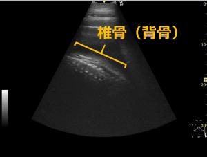 超音波検査画像（胸部）