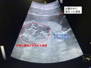 デナリの肝臓の超音波検査画像